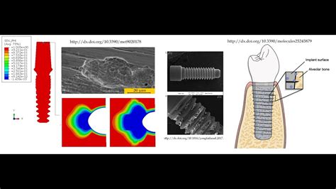 Modelling Corrosion In Dental Implant Using Uel Subroutine In Abaqus