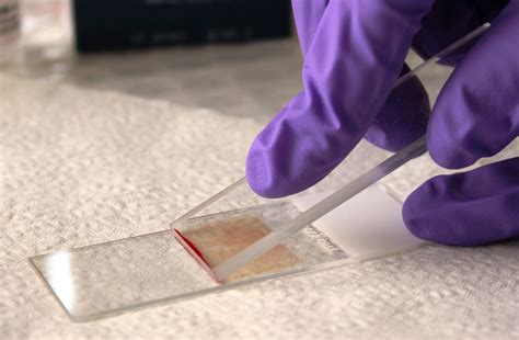 Mastering Your Blood Smear Technique Nabsnet