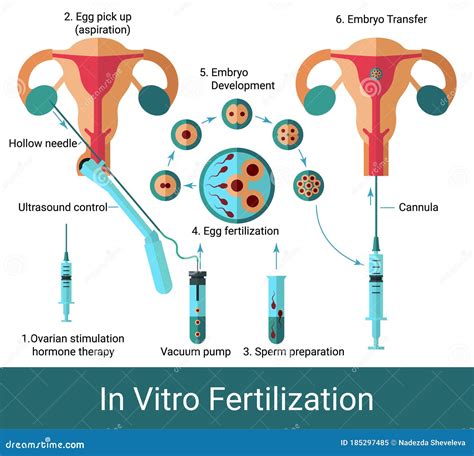 In Vitro Fertilization Infographic Chart Stock Vector Illustration