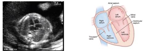 Dms Chapter Fetal Echocardiography Flashcards Quizlet