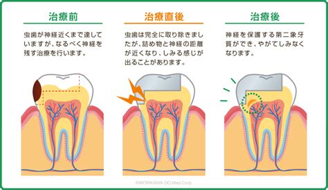 虫歯治療後の痛みについて 医療法人甦歯会 もりかわ歯科志紀診療所（志紀駅、八尾市、歯科医院）口コミのある歯医者