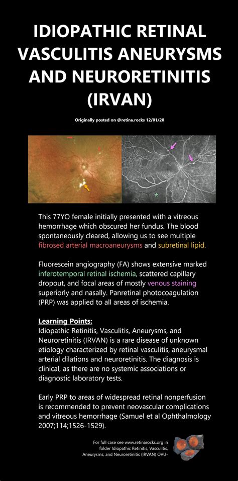 Retinal Vasculitis