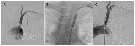 Vascular Disease Patient Information Page Subclavian Artery Stenosis Shireen R Khoury