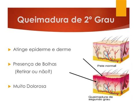 Primeiros Socorros Queimaduras