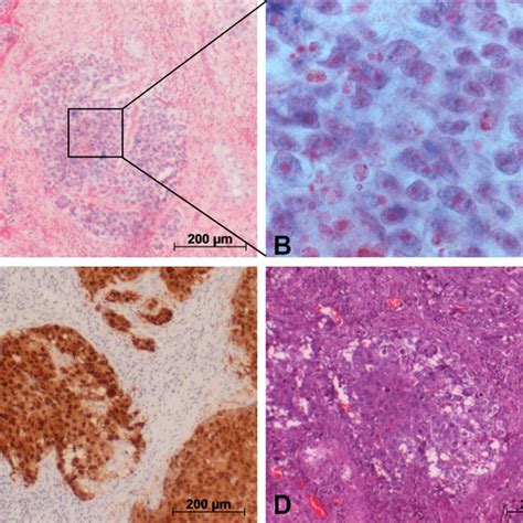 Detection Of Mir A P In Gct Tumor Ec Via In Situ Hybridization