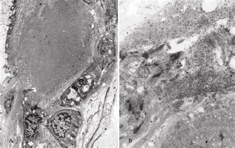 A B Amyloid Deposits In The Vascular Wall Of A Renal Arteriolar Vessel