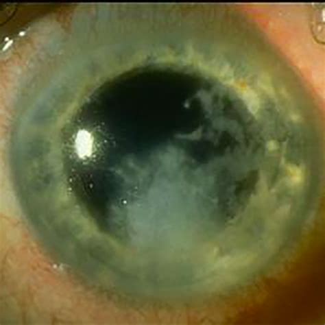 Fungal Corneal Ulcers Global Sight Alliance