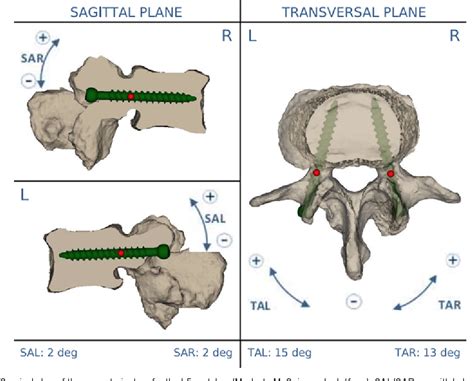 Figure 1 From Patient Specific Template Guided Versus Standard Freehand