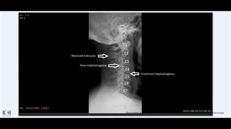 Rtg Odcinka Szyjnego Kr Gos Upa Dyskopatia I Zmiany Przeci Eniowe