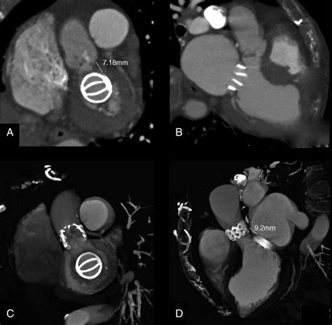 Direct Transfemoral Aortic Valve Implantation In A Patient With A