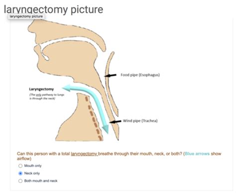 Total Laryngectomy Vs Tracheostomy Flashcards Quizlet