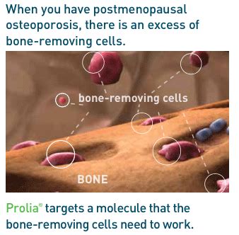 Prolia Injections For Osteoporosis We Have Many Treatments For Back Pain