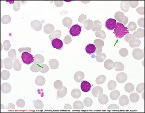 Chronic Lymphocytic Leukaemia Classic Morphology Cell Atlas Of