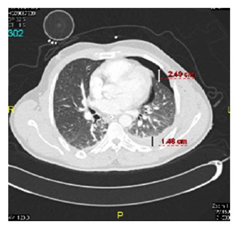 A Chest Radiograph And B Corresponding CT Scan Of Patient With