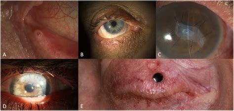 Frontiers Challenges And Concepts In The Diagnosis And Management Of Ocular Graft Versus Host