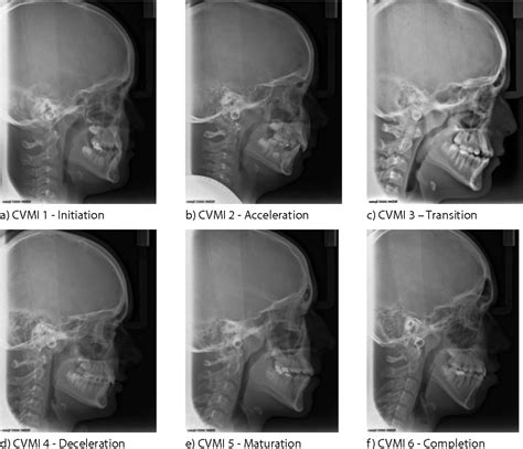 Figure From Skeletal Maturity Assessment Using Mandibular Canine