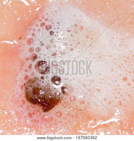 Wound On Human Skin Image Photo Free Trial Bigstock