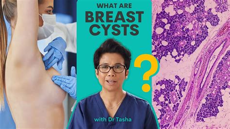 Demystifying Breast Cysts What You Need To Know With Dr Tasha Youtube