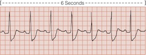 Interpret Atrioventricular Dysrhythmia Waveforms And Prioritize Effective Collaborative Care