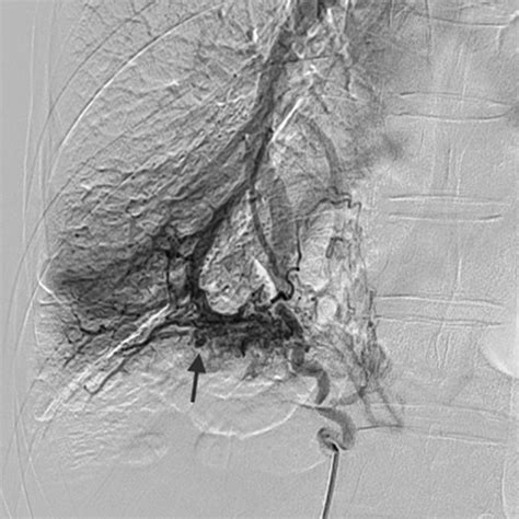 Bronchial Embolisation For Infected Pulmonary Artery Pseudoaneurysms Causing Haemoptysis