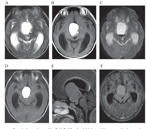 Figure From Fluid Fluid Level On Magnetic Resonance Images May