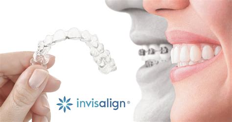 Ortodoncia Invisalign La Ortodoncia Invisible Aparato Invisalign