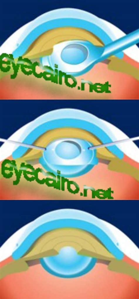 Icl Eye Of Cairo Dr Khalil Eye Clinic