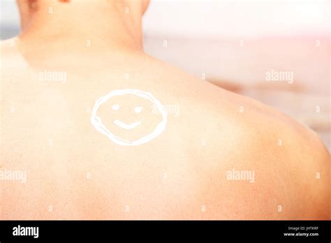 Skin Burn Shoulder Hi Res Stock Photography And Images Alamy