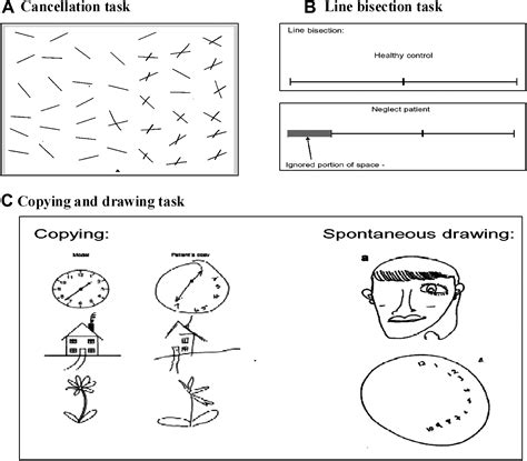 Visual Neglect Following Stroke Current Concepts And Future Focus Survey Of Ophthalmology