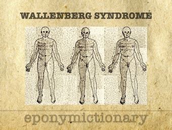 Lateral medullary syndrome Archives • LITFL