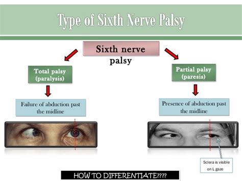 Sixth nerve palsy