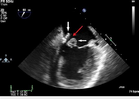 Transesophageal Echocardiogram With A Mid Position View Displaying A Download Scientific