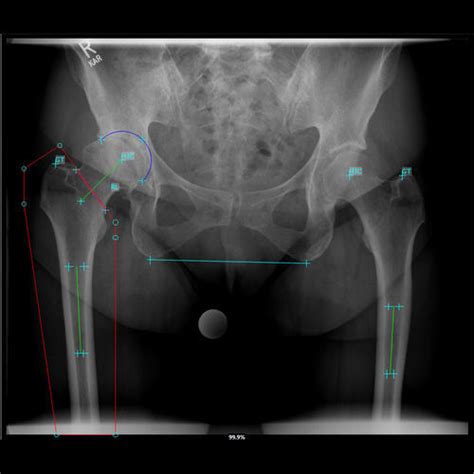 Preoperative Software Medicad Hectec Orthopedic Surgery For Hip Surgery Image Analysis