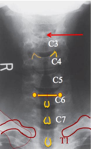 Cervical Radiograph Ap Lower Cervical Spine Diagram Quizlet