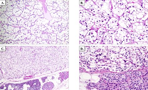 Histological Attributes Of Parathyroid Water Clear Cell Adenomas