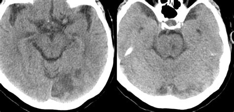 Index Of Wp Content Uploads Archives Stroke Basilar Stenting