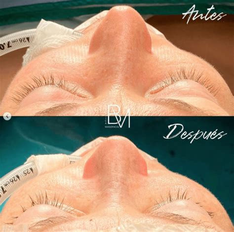 Rinoplastia Ultrasónica Antes Y Después Perspectivas Dra Moralejo