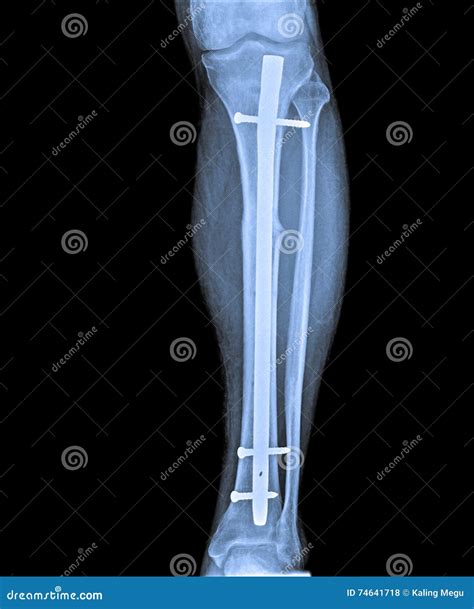 X Ray Of Leg With Fracture And Implant Stock Photo - Image: 74641718