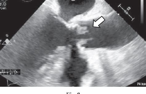 Figure 2 From A Case Of Prosthetic Infective Endocarditis With Acute Myocardial Infarction Due