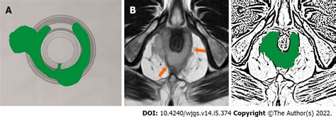 A 47 Year Old Male Patient With High Posterior Intersphincteric Anal