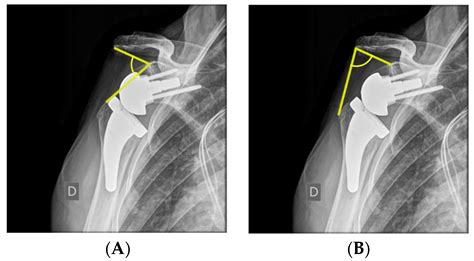 Challenges For Optimization Of Reverse Shoulder Arthroplasty Part Ii