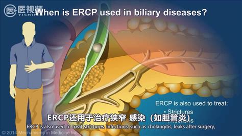 医学双语科普：ercp（内窥镜逆行胰胆管造影）新浪新闻