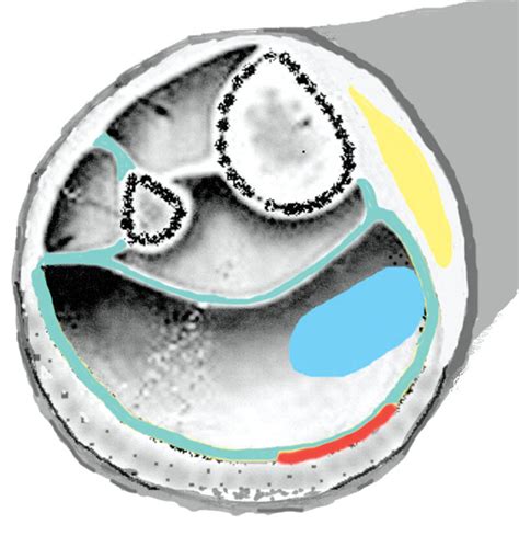 Schematic Representation Of Fascial Compartments Of Leg At Mid Leg