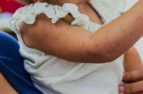 Roseola Symptoms, Types, Causes, Risk Factors, & more - blog.cult.fit