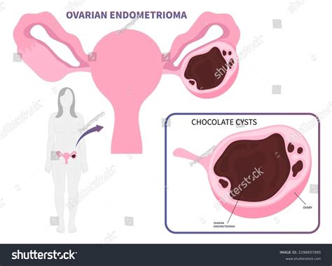 Chocolate Ovarian Cyst