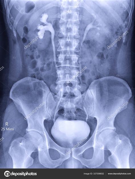 Intravenous Pyelogram Ray Exam Urinary Tract Injection Contrast Media