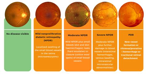 Diabetic Retinopathy Thind Eye Hospital