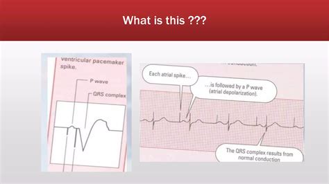 Pacemaker Ppt