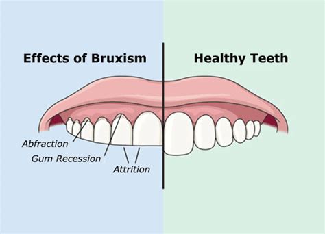 Bruxism Treatment Grinding Guard Advance Dental Pc Dentist Birmingham Al