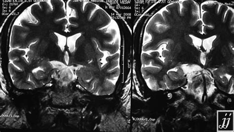 Epidermoid Cyst Radiopaedia